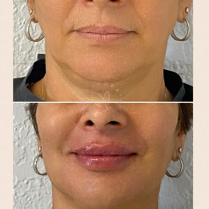 Face treated with Sculptra