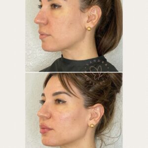 Face treated with Sculptra